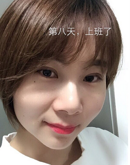武汉天佑医院整形美容科做双眼皮怎么样?