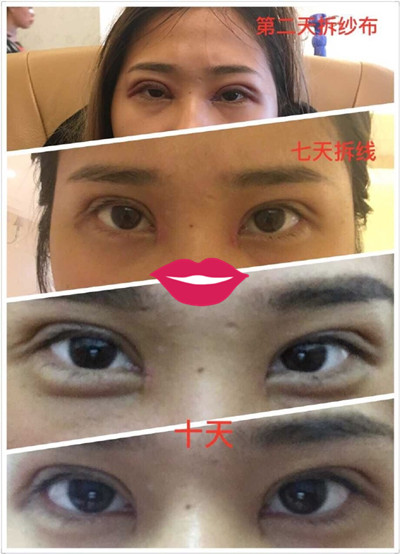 南宁华美整形美容医院卢医生做的双眼皮果