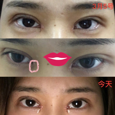 南宁华美整形美容医院卢医生做的双眼皮果