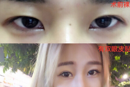 南宁华美整形美容医院卢医生做的双眼皮果