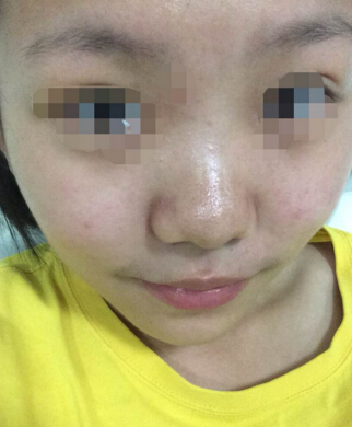 北京幸福医疗美容医院柳龙春做的硅胶隆鼻果