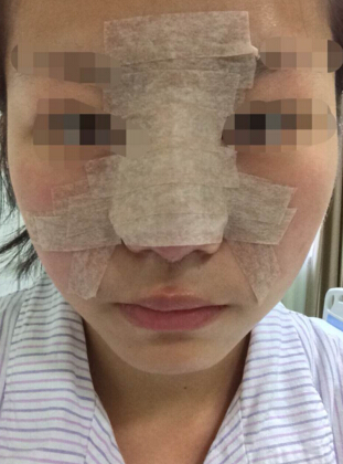 北京幸福医疗美容医院柳龙春做的硅胶隆鼻果
