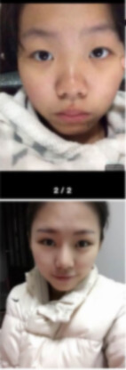 北京幸福医疗美容医院柳龙春做的硅胶隆鼻果