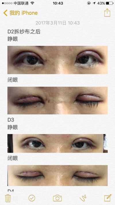 上海九院程辰医生做的全切双眼皮手术果
