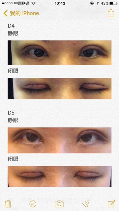 上海九院程辰医生做的全切双眼皮手术果