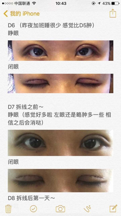 上海九院程辰医生做的全切双眼皮手术果