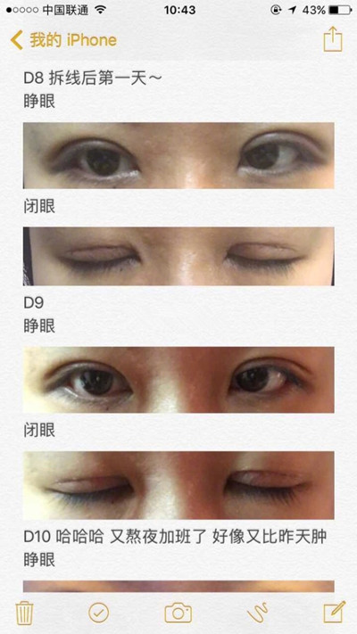 上海九院程辰医生做的全切双眼皮手术果