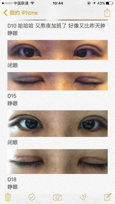 上海九院程辰医生做的全切双眼皮手术果