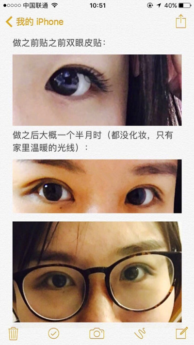 上海九院程辰医生做的全切双眼皮手术果