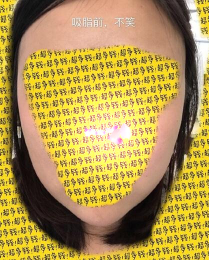 北京陈晓芳医生价格一万一做的多方面部吸脂