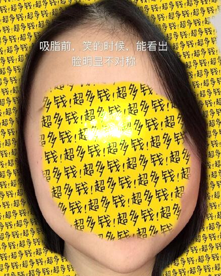 北京陈晓芳医生价格一万一做的多方面部吸脂
