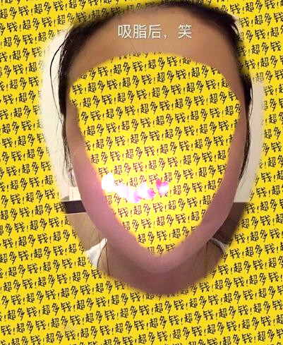 北京陈晓芳医生价格一万一做的多方面部吸脂