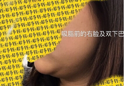 北京陈晓芳医生价格一万一做的多方面部吸脂