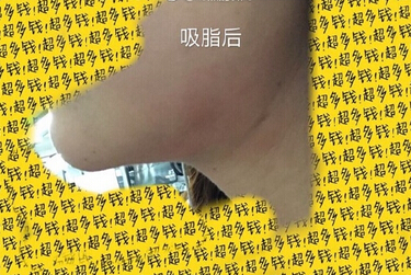 北京陈晓芳医生价格一万一做的多方面部吸脂