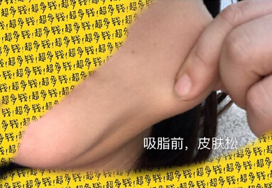 北京陈晓芳医生价格一万一做的多方面部吸脂