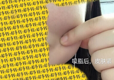 北京陈晓芳医生价格一万一做的多方面部吸脂