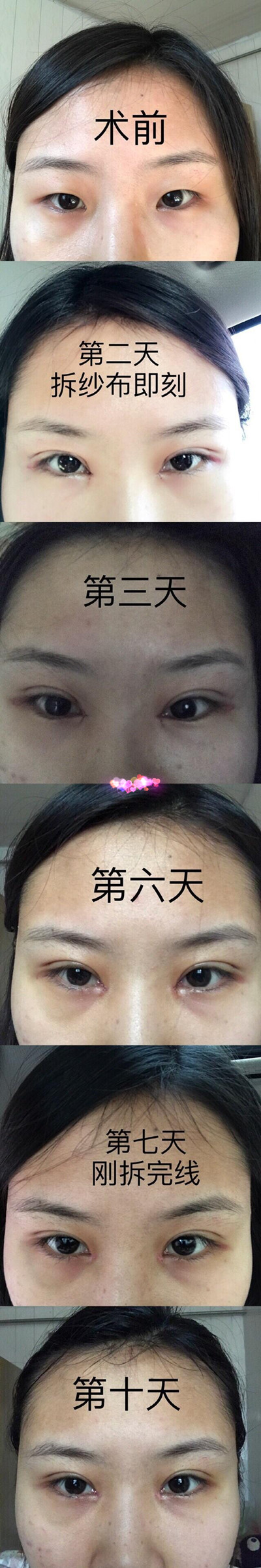 石家庄美联臣翟主任的双眼皮开眼角果