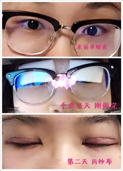 北京八大处尹宏宇医生做的全切双眼皮果