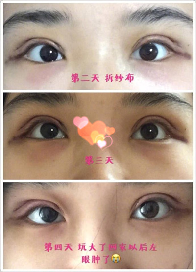 北京八大处尹宏宇医生做的全切双眼皮果