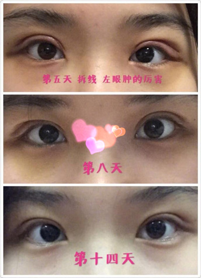 北京八大处尹宏宇医生做的全切双眼皮果