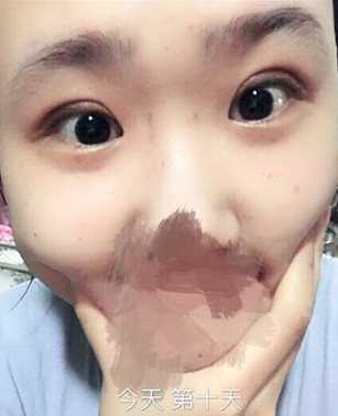 厦门脸博士整形价格3300做的双眼皮手术果