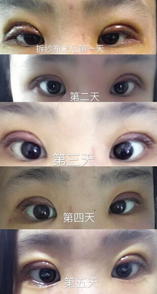 厦门脸博士整形价格3300做的双眼皮手术果