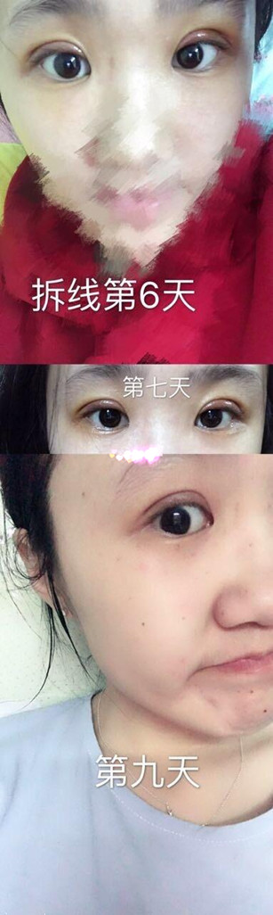 厦门脸博士整形价格3300做的双眼皮手术果