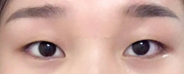 哈医大群力分院孙延昌任处做的双眼皮手术