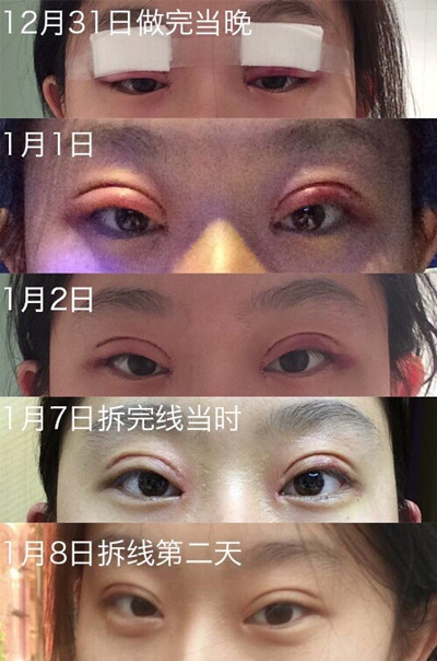 【案例分享】成都铜雀台徐敦医生双眼皮开眼角