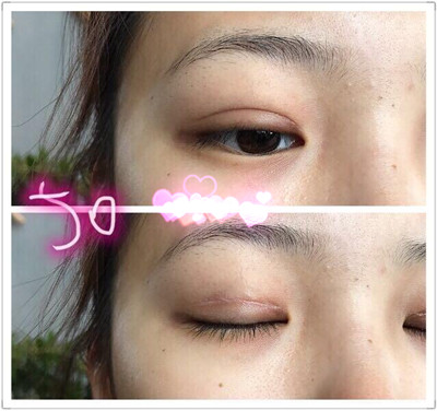 邯郸爱尔眼科梁玉珍主任做双眼皮果分享