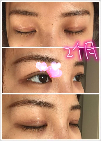 邯郸爱尔眼科梁玉珍主任做双眼皮果分享