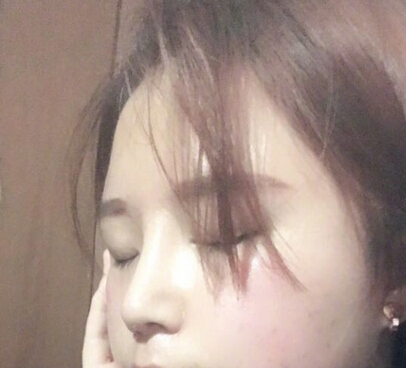宁波珈禾整形医院费安军做的鼻部手术整形手术