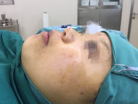 宁波珈禾整形医院费安军做的鼻部手术整形手术