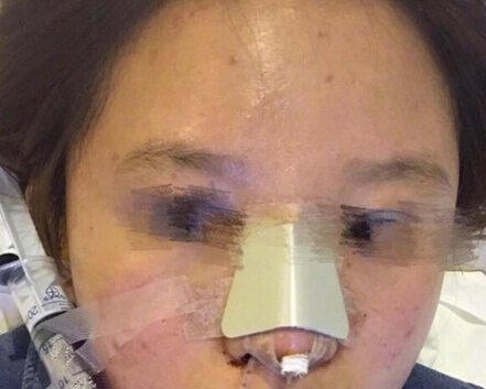 宁波珈禾整形医院费安军做的鼻部手术整形手术