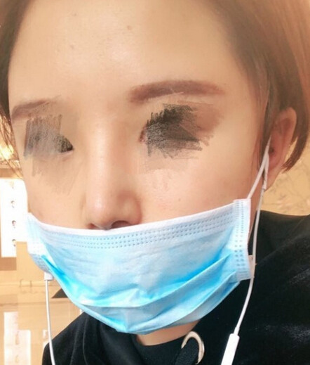 宁波珈禾整形医院费安军做的鼻部手术整形手术