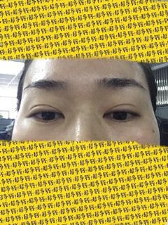 帮我看看我的双眼皮肉条和疤痕还有救吗?