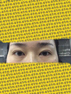 帮我看看我的双眼皮肉条和疤痕还有救吗?