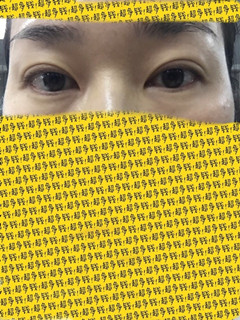 帮我看看我的双眼皮肉条和疤痕还有救吗?