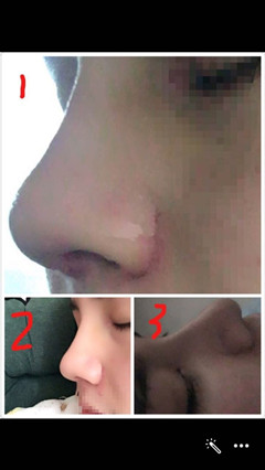 重庆西南毕胜医生做的鼻部手术整形手术