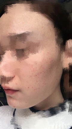 重庆西南毕胜医生做的鼻部手术整形手术