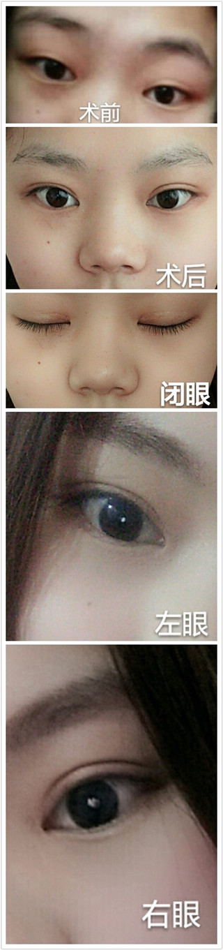 我的鼻子做单纯隆鼻,还是要鼻部手术?