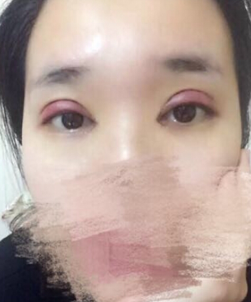 唐都医院刘纲医生做双眼皮开眼角果