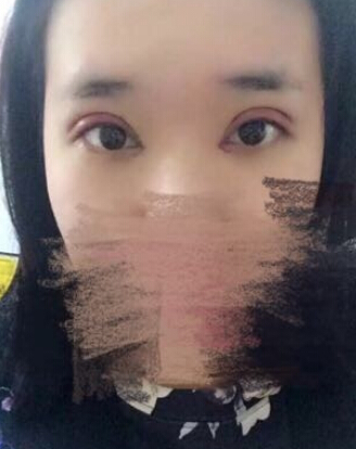 唐都医院刘纲医生做双眼皮开眼角果