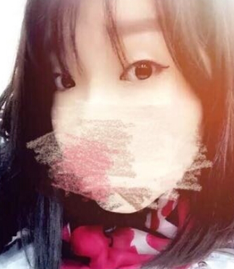 唐都医院刘纲医生做双眼皮开眼角果
