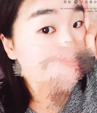 唐都医院刘纲医生做双眼皮开眼角果