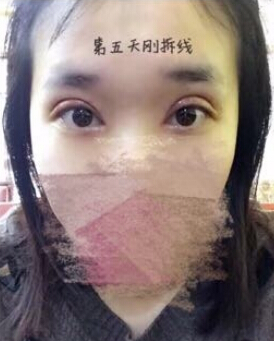 唐都医院刘纲医生做双眼皮开眼角果