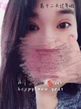 唐都医院刘纲医生做双眼皮开眼角果