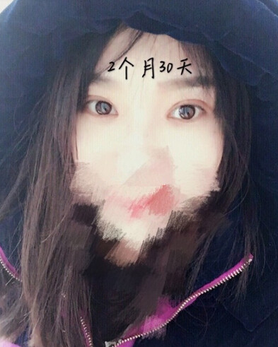 唐都医院刘纲医生做双眼皮开眼角果