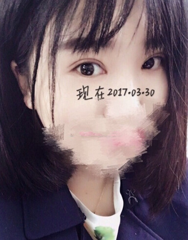 唐都医院刘纲医生做双眼皮开眼角果