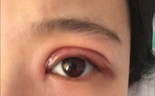 北京八大处王太玲做双眼皮果怎么样?